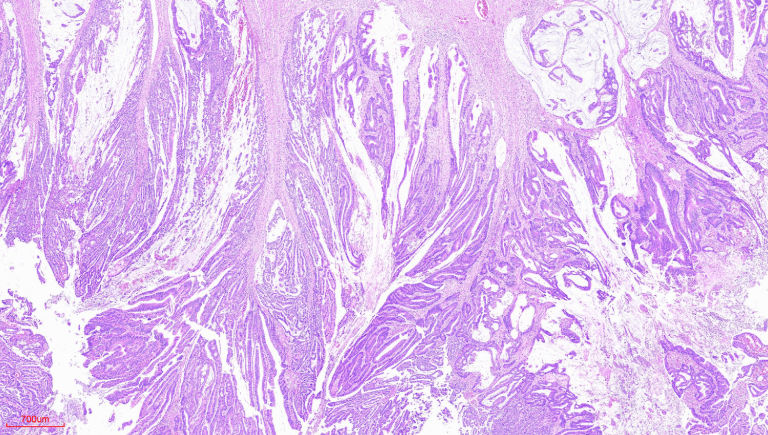 image of colorectal tumor tissue microarray