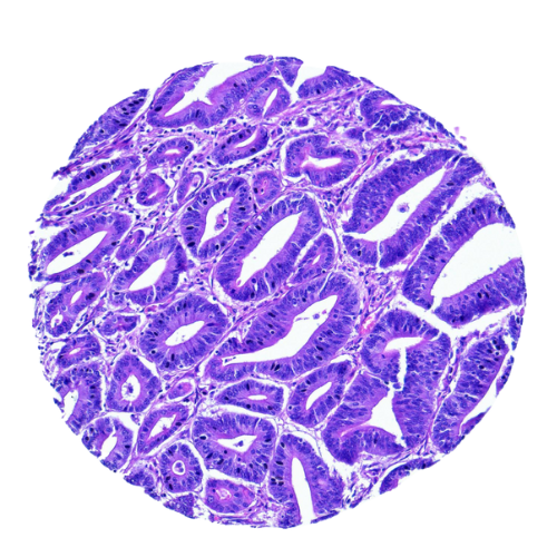 Human Tissue Microarray | Colorectal Tumor Tissue Microarray (53 cases) – TC003