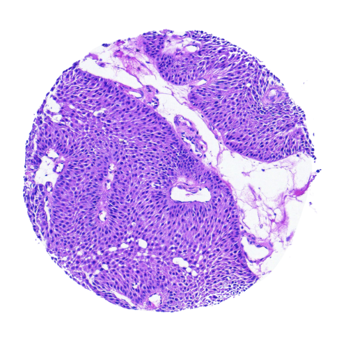 Bladder Tumour Tissue Microarray (57 cases) - TBL001