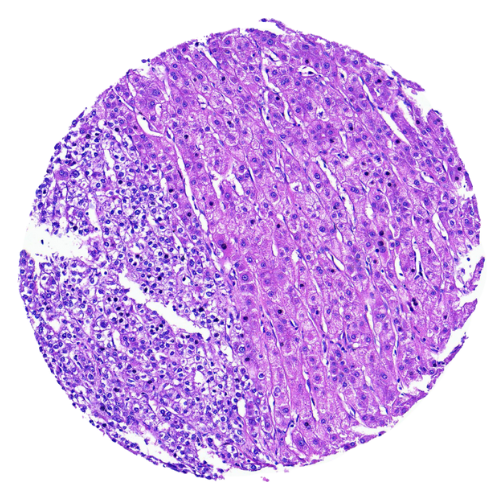 Liver Tumour with Matched Adjacent Tissue and Gallbladder Tumour Tissue Microarray (39 cases) - TLI001