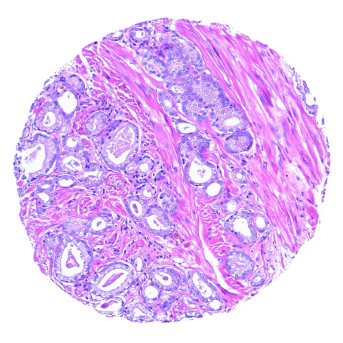 Prostatic Tumour Tissue Microarray