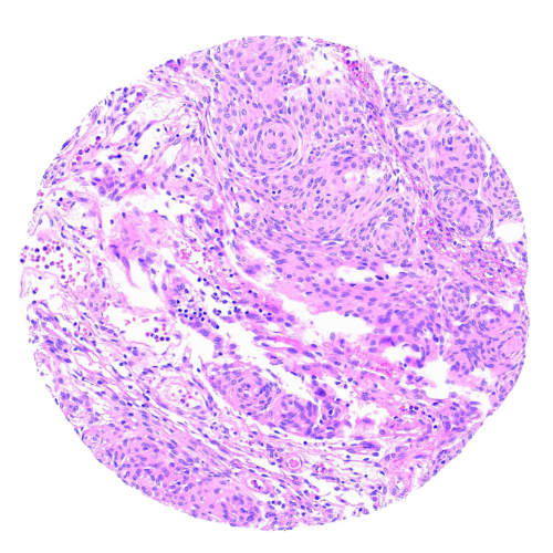 Brain Tumour Tissue Microarray (16 cases) – TBR002A