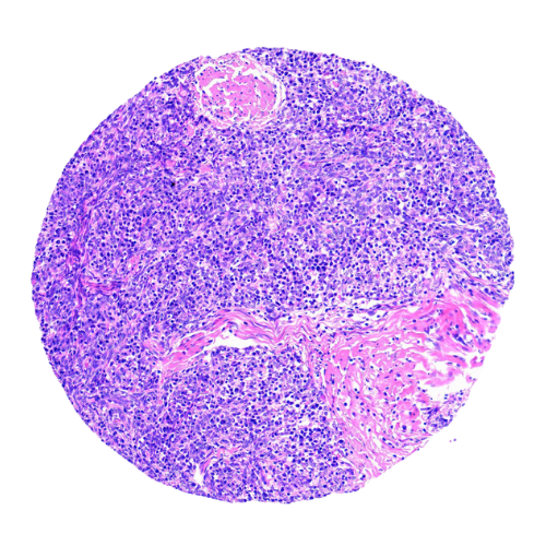 Thymic Tumour Tissue Microarray (20 cases) – TTM002