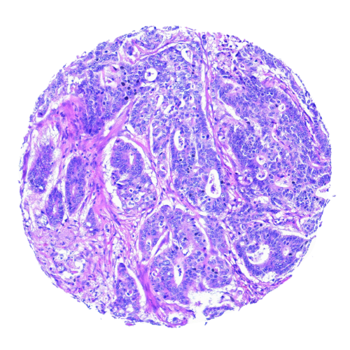 Caecal Tumour Tissue Microarray (17 cases) – TCC001