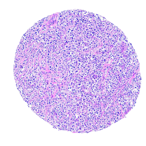 Lymphoma Tumour Tissue Microarray (43 cases) – TLY001