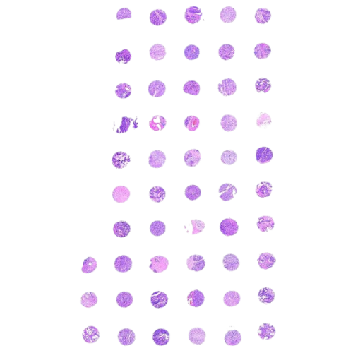 Mixed Gastrointestinal Tract Tumour Tissue Microarray (50 cases) – TMX002