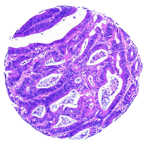 Mixed Gastrointestinal Tract Tumour Tissue Microarray (50 cases) – TMX002