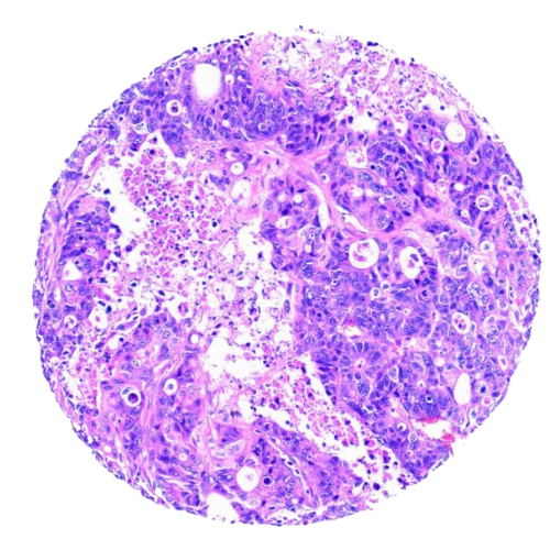 Mixed Gastrointestinal Tract Tumour Tissue Microarray (50 cases) – TMX002