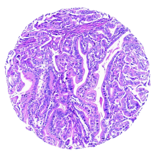 Mixed Gastrointestinal Tract Tumour Tissue Microarray (50 cases) – TMX002