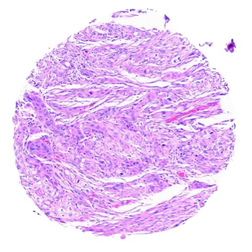 Mixed Gastrointestinal Tract Tumour Tissue Microarray (50 cases) – TMX002