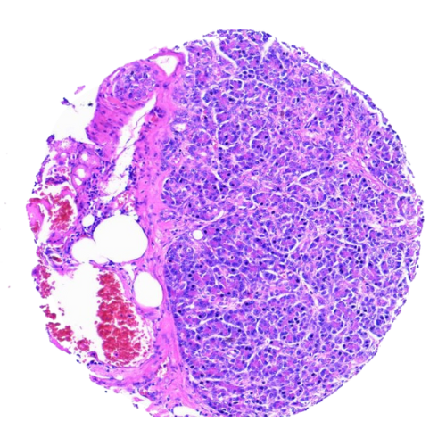Mixed Gastrointestinal Tract Tumour Tissue Microarray (50 cases) – TMX002