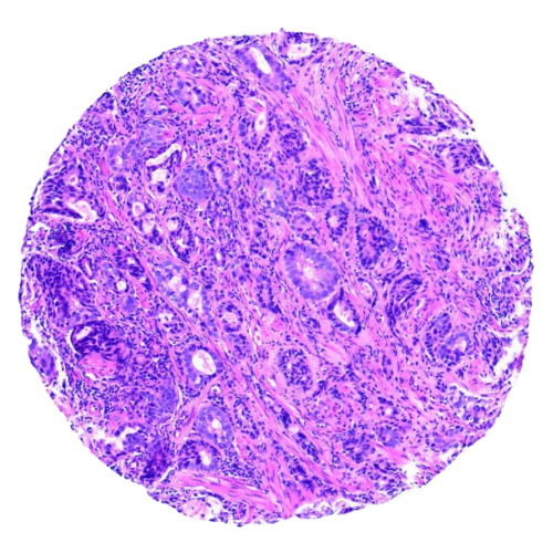 Mixed Gastrointestinal Tract Tumour Tissue Microarray (50 cases) – TMX002