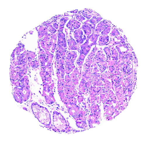 Mixed Gastrointestinal Tract Tumour Tissue Microarray (50 cases) – TMX002