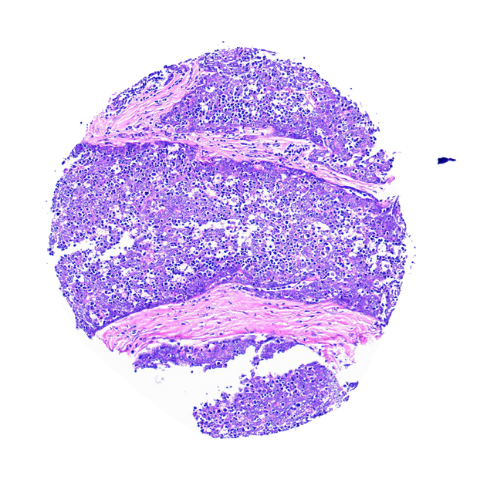 Thymic Tumour-Matched Adjacent Tissue Microarray (19 cases) – TTM001