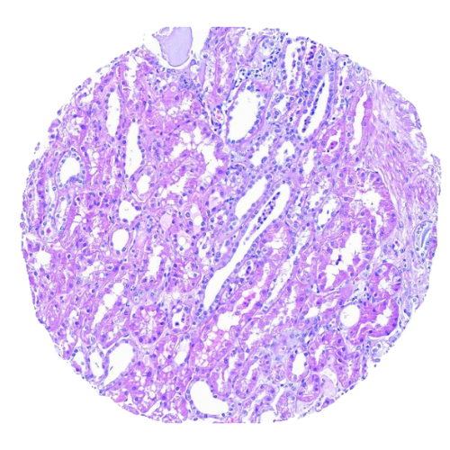 Kidney Tumour Tissue Microarray (52 cases) – TK001 (1) Kidney Tumour Tissue Microarray (52 cases) – TK001
