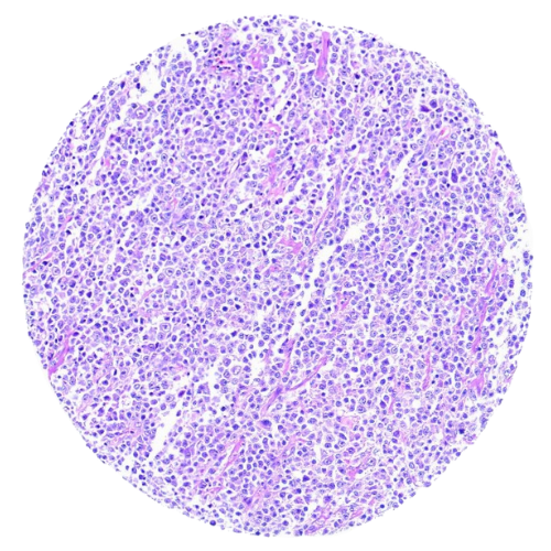 Lymphoma Tumour Tissue Microarray (63 cases) – TLY002
