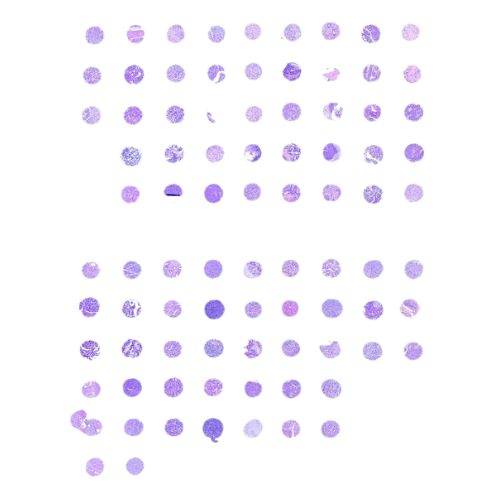 Mixed Tumour Tissue Microarray (83 cases) – TMX008 all Mixed Tumour Tissue Microarray (83 cases) – TMX008